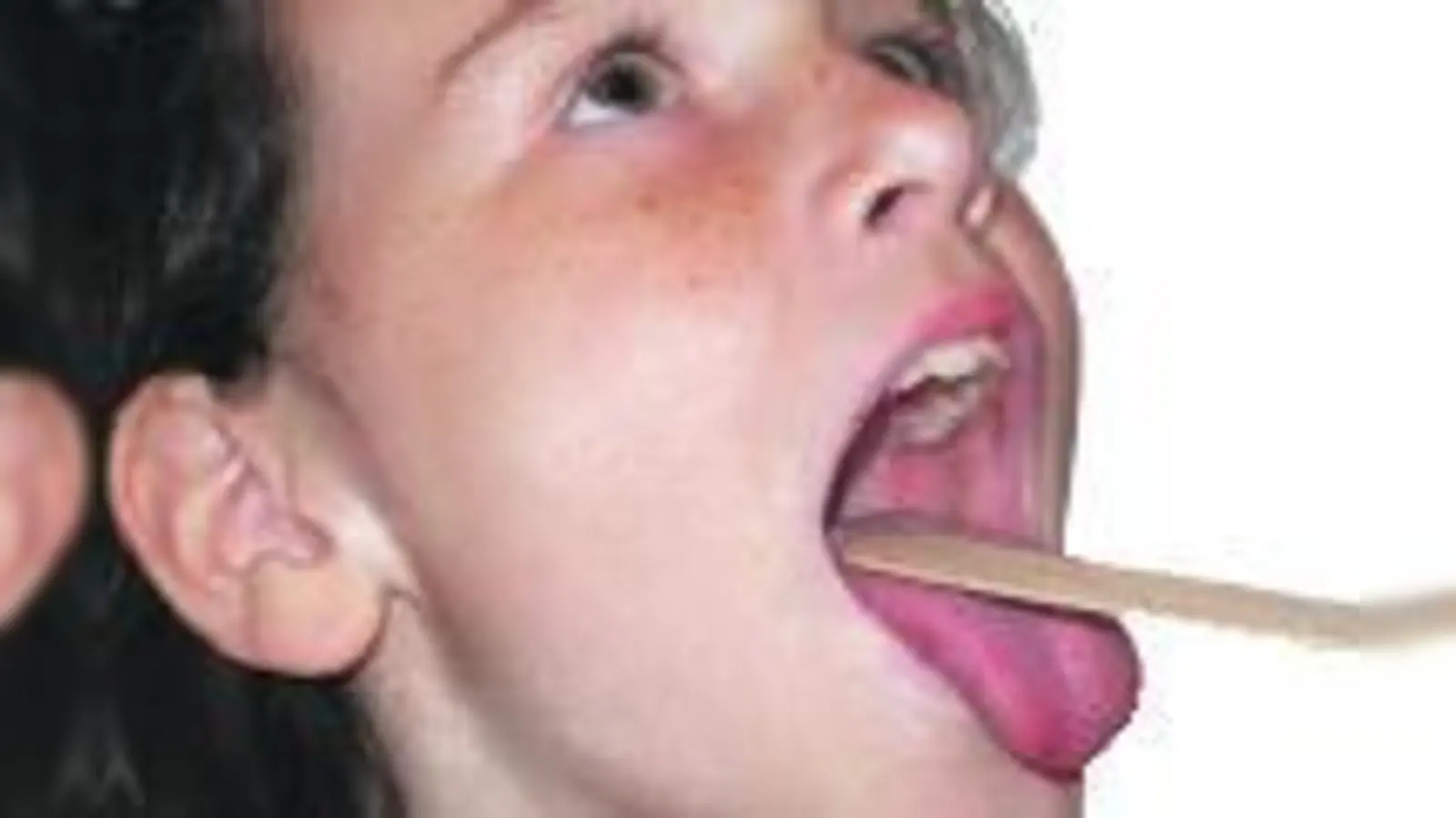 Sag mal aaaaa: Wer Masern hat, muss zum Arzt.           (Foto: Archiv)