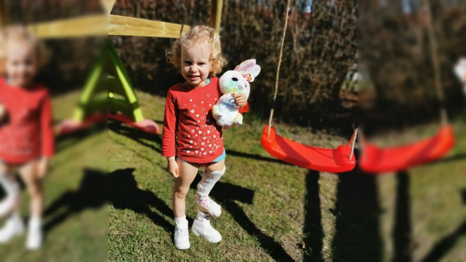 Deutsche-Lebensbrücke-Kind Filippa. Ihr linkes Bein ist zu kurz. (Foto: Deutsche Lebensbrücke)