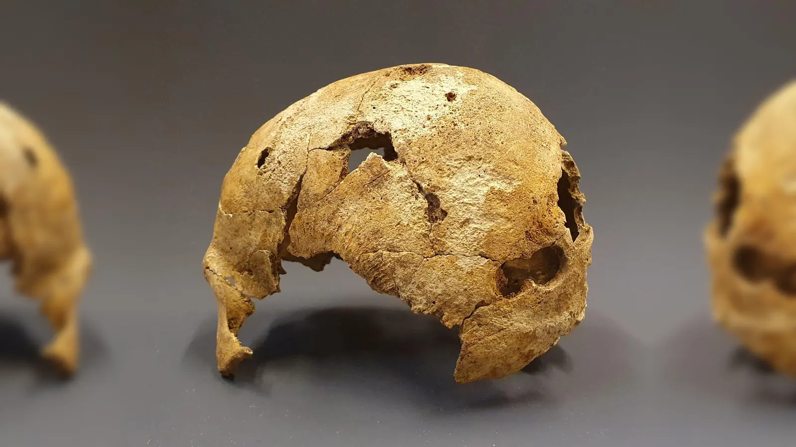 Schädel einer Frau, in deren Hinterhaupt sich mehrere Trepanationen zeigen. Dies sind Aufbohrungen der Schädeldecke, die in diesem Fall möglicherweise heilkundlich motiviert waren.  (Foto: AschheiMuseum)