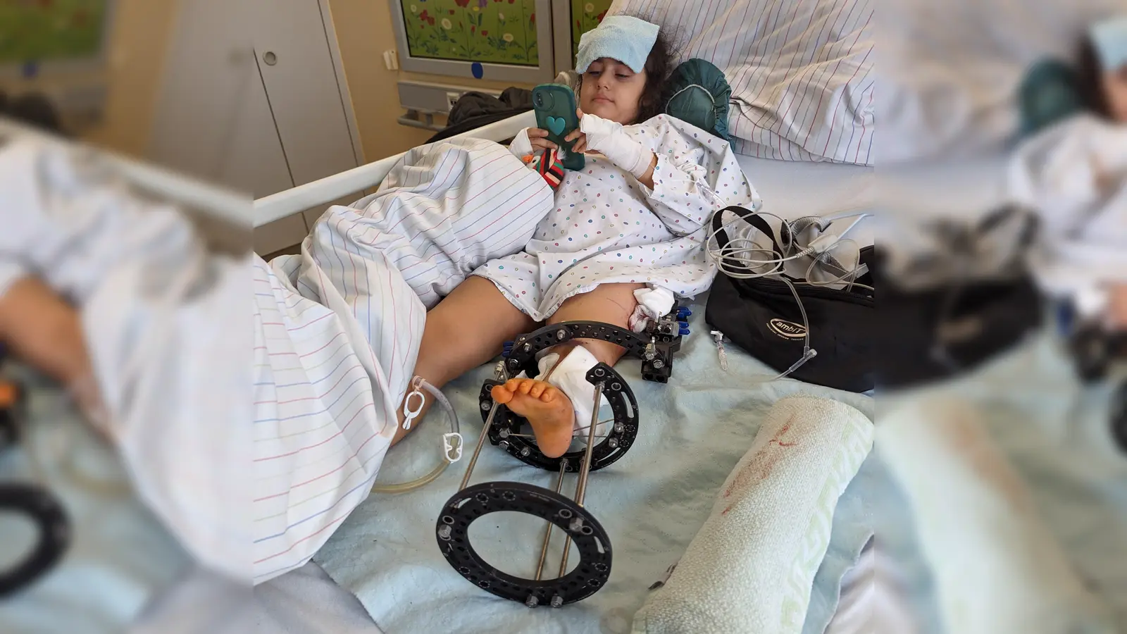 Aza hat die OP gut überstanden. Über zwei Schienen , s.g. Fixateurs, werden ihre Knochen verlängert. (Foto: Deutsche Lebensbrücke)