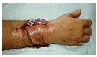 Bei einem Unfall mit einer Kreissäge trennte sich ein Handwerker die Hand ab: Die Chirurgen des MRI nähten die Hand wieder an.	Foto: MRI