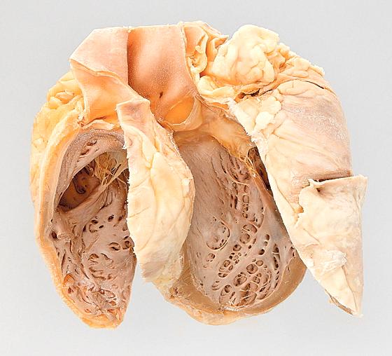Plastinat eines stark vergrößerten menschlichen Herzens (»Bierherz«) aus dem Institut für Pathologie, Klinikum Schwabing.	Foto: Philipp Mansmann