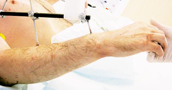 In einer weltweit einzigartigen Operation nähte ein Chirurgen-Team des MRI Karl Merk zwei neue Arme an, die er bei einem Unfall verloren hatte.	Foto: MRI
