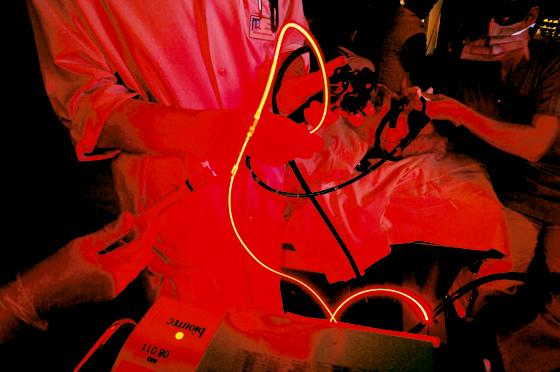 Laserlicht wird durch eine millimeterdünne Faser geleitet, die durch das Endoskop bis an Tumore des Gallenganges vorgeschoben wird.	Foto: StKM